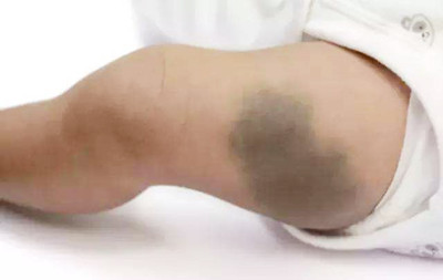 為什么會長胎記?可以祛除嗎?