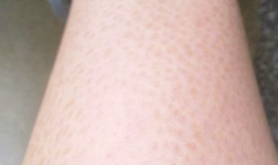 長春魚鱗病治療大概需要多少錢