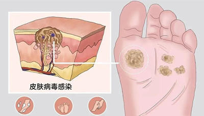 瘊子是疣嗎?能傳染嗎