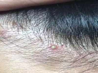 ^ƤLēʲôԭ?q)µģ? /></div>
<p><strong>^Ƥ֬Ƥ</strong></p>
<p>֬ƤַQ֬ԝǰl(f)Ƥ֬SλһN[мװYƤwҊڳ˺ðl(f)^桢|ɵƤ֬S^(q)</p>
<p>Y^Ƥ֬ƤƤpF(xin)ë܇tɫСԺƤ໥ں϶ɴСȵStɫƬϸā[мƤ߿ɰНBͺ裬(yn)ز(g)^āԺ裬гζ[мճ^ƤȥoĤF(xin)c(din)Ѫ^l(f)͡ϡ١WȰYol(f)</p>
<p>ע(xing)һ̎Ҏ(gu)ɡ˯߳㡢{(dio)ʳ߲˺ˮ֬ͶʳƼ̼ʳͬr(sh)Ҫ^ȵľo</p>
<p><strong>^Ƥyм</strong></p>
<p>yм׷QţƤ_һNװYƤw^L׏(f)l(f)AеĲ׺Kԓl(f)(du)ߵw;rӰ^</p>
<p>Y^Ƥyмc(din)Ƥpذl(f)Hֲɾޣɷl(f)(g)^ƤyɫSɫ[мƤp̎ël(f)e[мosqëPël(f)ol(f)Ó䣬“l(f)”c(din)</p>
<p>yмĵ͓pһ(g)tɫ߉K(hu)^yɫ[м޺γ@Щ[мԺ󣬿Կ·һ(g)tɫl(f)ģ͸ıĤٰѱĤ^m(x)εԺ󣬕(hu)ڱĤ·c(din)ѪĬF(xin)ԱĤF(xin)c(din)ѪyмԵēp</p>
<p><a href=