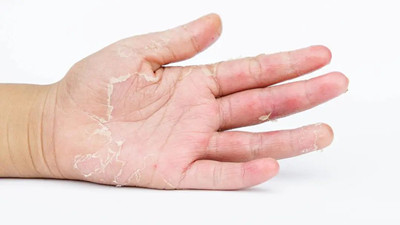 一到換季手就脫皮,究竟是哪種皮膚病在作祟?