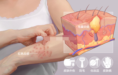 長春毛囊炎怎么治療好